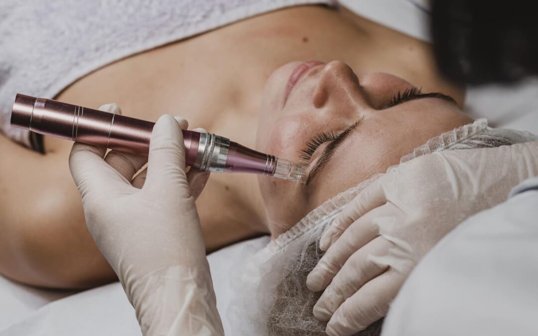 Exosomas Vitoria: regeneración avanzada de la piel con Dermapen en Xarma Belleza